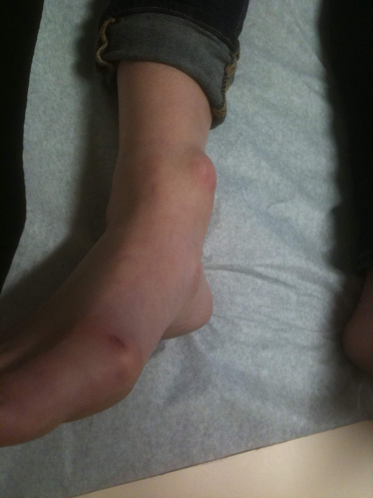 Ankle Giant Cell Tumour